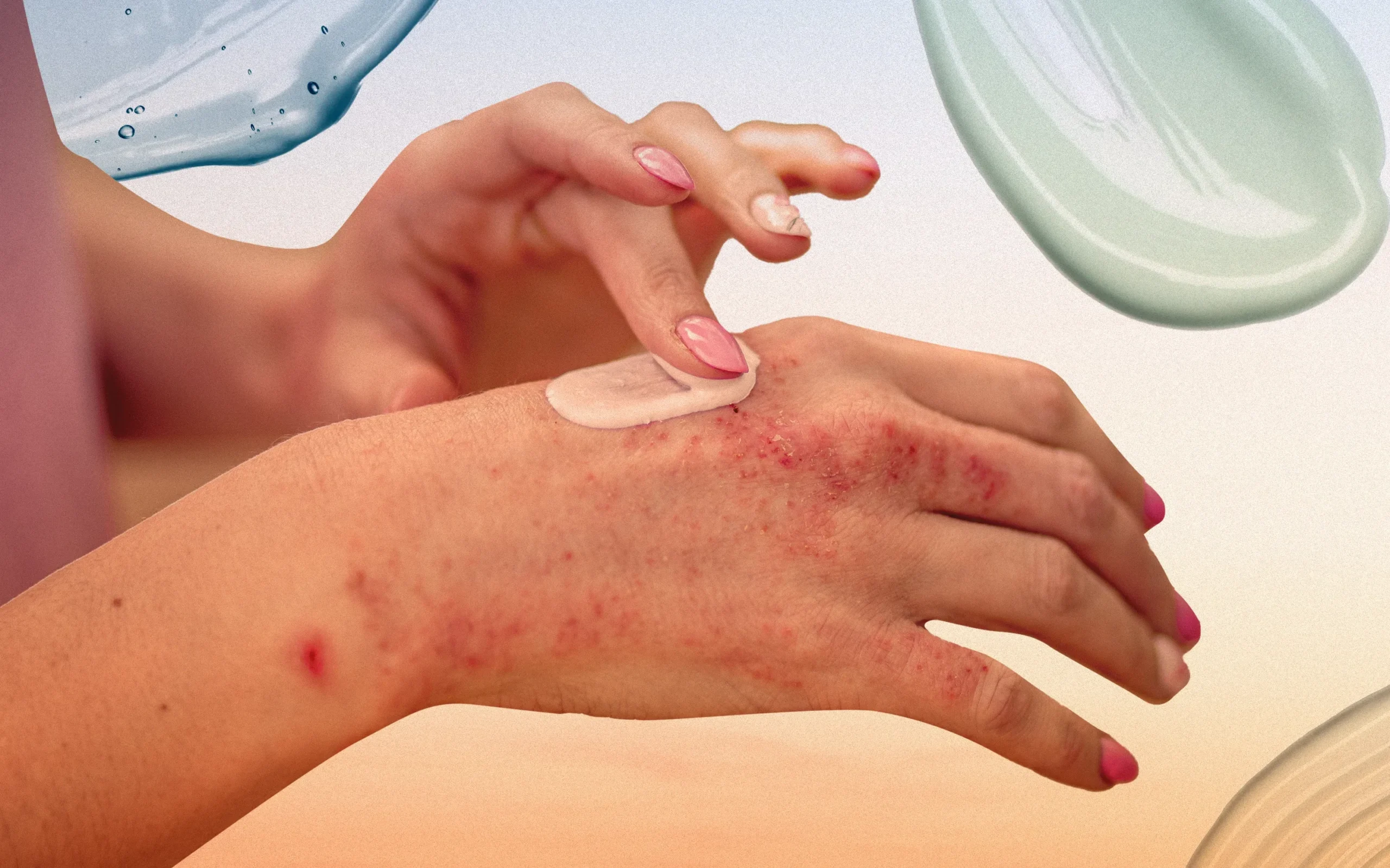 psoriasis ka desi ilaj