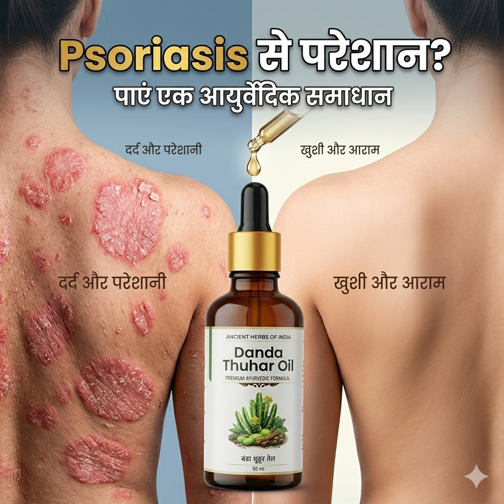Danda Thuhar Psoriasis oil for scaly patches, Eczema and Psoriasis Treatment | दाद, खाज और खुजली का तेल